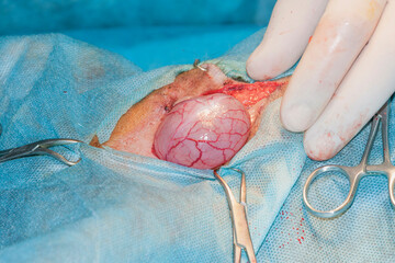 Bladder before the cut. Surgery to remove stones from the bladder