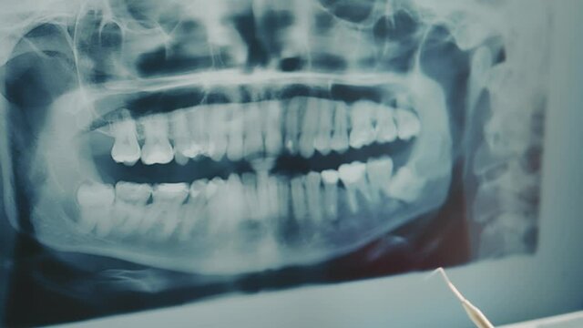 The dentist examines a panoramic x-ray of the teeth. The dentist shows the problem teeth on the X-ray of the teeth with his finger.