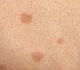 Fototapeta premium round skin burns from hot oil