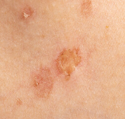 Fototapeta premium round skin burns from hot oil