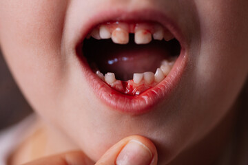 close-up of an open baby's mouth with bloody blisters and bleeding from the wound of a removed baby...