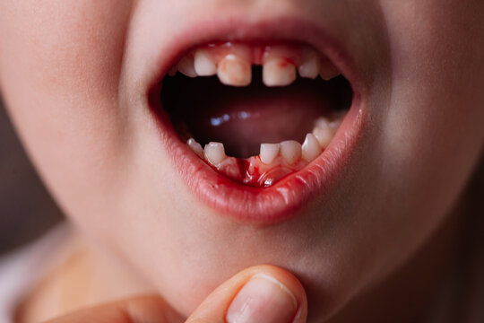 close-up of an open baby's mouth with bloody blisters and bleeding from the wound of a removed baby tooth on the lower jaw.