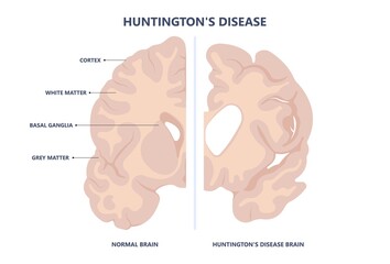 Huntington parkinson Motor alzheimer neuron brain DNA gene nerve cell juvenile problem defect genetic basal ganglia neuro repeat mutant damage testing defective mood inherits system family memory loss