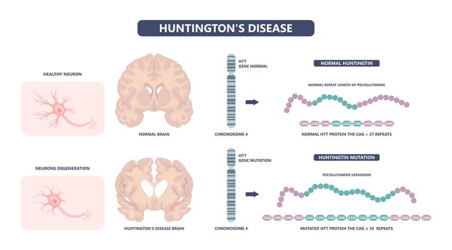 Huntington Parkinson Motor Alzheimer Neuron Brain DNA Gene Nerve Cell Juvenile Problem Defect Genetic Basal Ganglia Neuro Repeat Mutant Damage Testing Defective Mood Inherits System Family Memory Loss