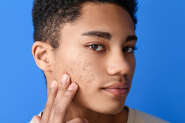 African-American teenage boy with acne problem on color background