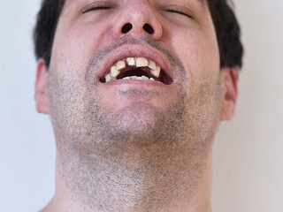 Obraz premium portrait of a man with broken teeth