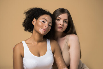 Vitiligo skin girl and plus size woman posing together