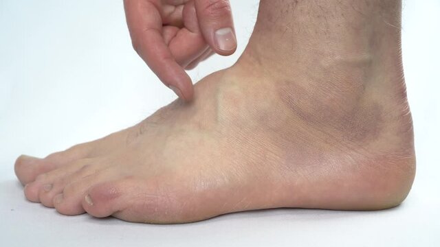A man touches a leg on which a hygroma. Articular hernia on the leg. Closeup.