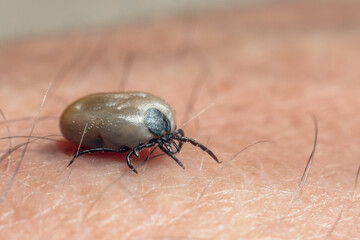 A tick drunk on blood crawls on human skin