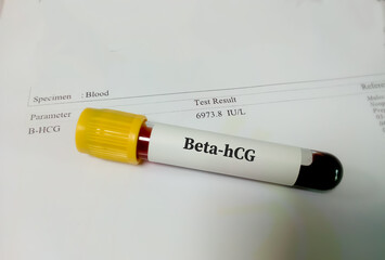 Blood sample for Beta hCG hormone test with result, health and medical concept