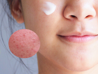 Image acne skin in zoom circle before and after treatment on the face of young asian woman. Problem...