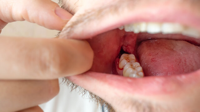 Close-up of a tooth gap in a male mouth for a dental implant with fresh open wound and blood, Germany