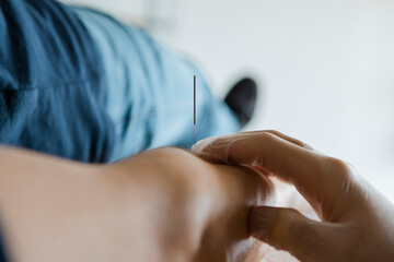 Obraz na płótnie Canvas Close up of a needle stuck into a male patient's arm during a Acupuncture session, Alternative treatment therapy of Dry needling, in a health center, medical office, clinic or hospital.
