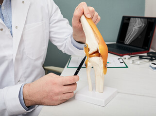 Human cruciate ligament injury treatment concept. Orthopedist showing to cruciate ligament in a knee-joint medical teaching model, close-up - obrazy, fototapety, plakaty