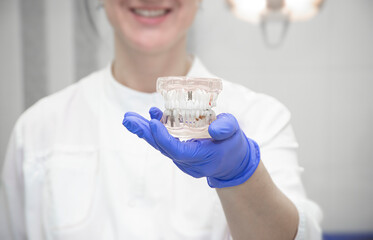 Smiling dentist hand in blue gloves hold an artificial model of the jaw with implants showing