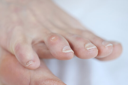 Closeup of dry callus on woman toe