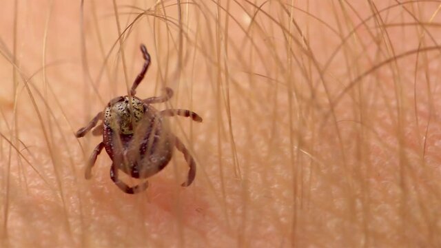 Macro Video of Encephalitis Tick Insect Crawling on Human Skin. Encephalitis Virus or Lyme Borreliosis Disease Infectious Dermacentor Tick Arachnid Parasite.