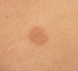round skin burns from hot oil