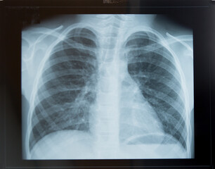 healthy child chest x-ray:the ribs and lungs without damage