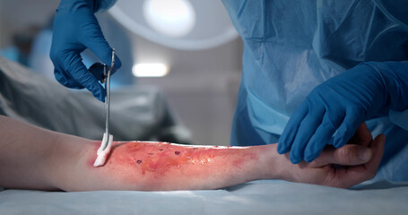 Surgeons team working with burn wound on arm of patient in operating room. - obrazy, fototapety, plakaty