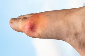 Large hematoma on the leg from a swollen joint