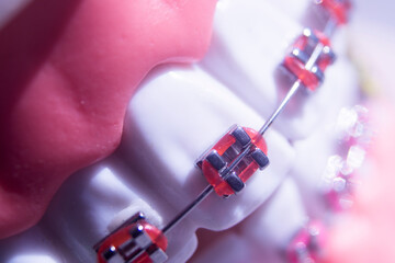 Metal teeth brackets