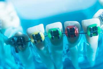 Metal teeth brackets