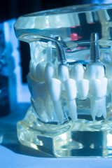 Dental tooth implant