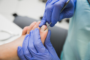 
Nail clip. A podiatrist treats an ingrown toenail. Medical pedicure procedure. Orthonyx Bracket - obrazy, fototapety, plakaty