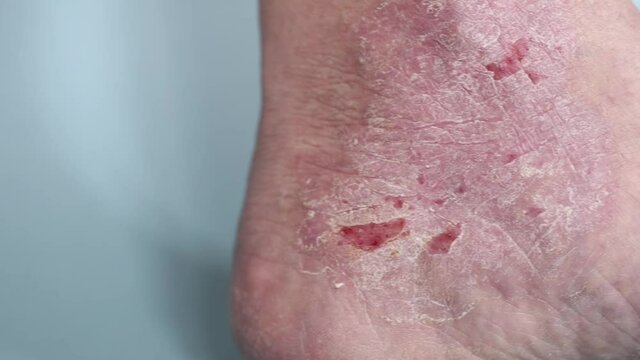 Psoriasis. Scratched area of the foot, affected by psoriatic plaques