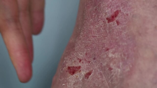 Psoriasis. The fingers of the hand touch the area of the foot affected by plaques