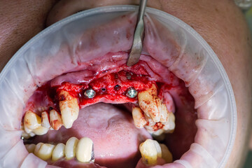 Surgery operation to install four dental implants on the upper jaw. Dental care and treatment. Teeth problems. © gorynvd