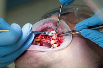 Surgery operation to install four dental implants on the upper jaw. Dental care and treatment. Teeth problems. © gorynvd