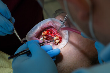 Surgery operation to install four dental implants on the upper jaw. Dental care and treatment. Teeth problems. © gorynvd