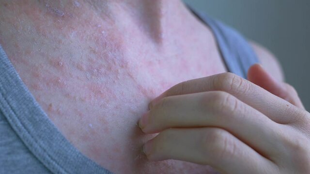 On an open area of the womans body, an allergic reaction is poured into a pinkish rash. With nails, remove the dried film from the inflammation. Viral diseases. Close-up.
