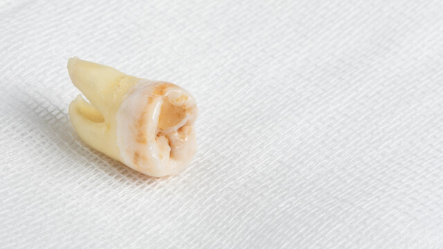 Pulled out wisdom tooth with filling and caries on white cheesecloth background. Close up of bad wisdom tooth