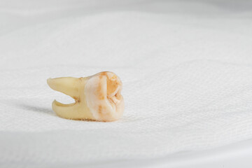 Pulled out wisdom tooth with filling and caries on white cheesecloth background. Close up of bad wisdom tooth