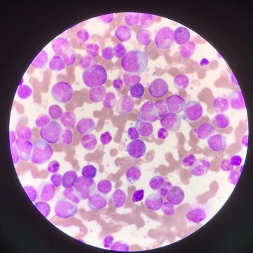 Leukemia blood picture find with microscope 1000X.
