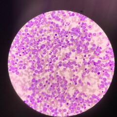 Leukemia blood picture find with microscope 400X.