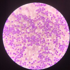 Leukemia blood picture find with microscope 400X.