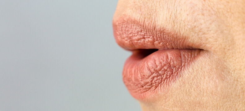 Women's lips are stretched out into a tube like a duck.