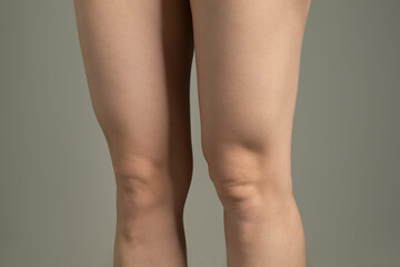 Fototapeta premium Fat folds above knees. Woman`s hips closeup raw studio shot in grey background. Dieting and fat loss concept.