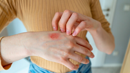 Young woman scratches the itching on her hands with a reddening rash. Itching is caused by dermatitis (eczema), dry skin, burns, food, drug allergies, insect bites. Health care concept.