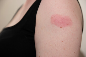Arm of white woman 48 hours after receiving covid-19 coronovirus vaccination, showing swollen red...
