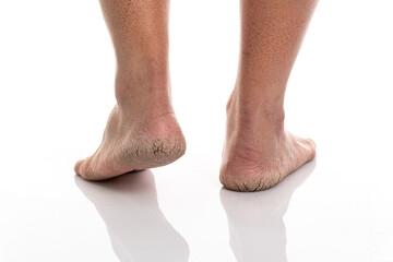 Close up of Cracks on Heels isolated white background