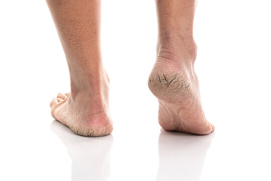 Close up of Cracks on Heels isolated white background