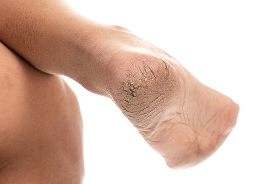 Close up of Cracks on Heels isolated white background