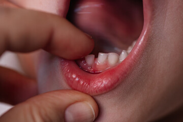 close-up change of temporary teeth, adult hand stragge baby tooth in child mouth.