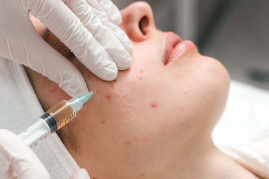 Acne Treatment