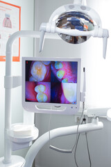 Screen in the dental office with a macro shot of the tooth.